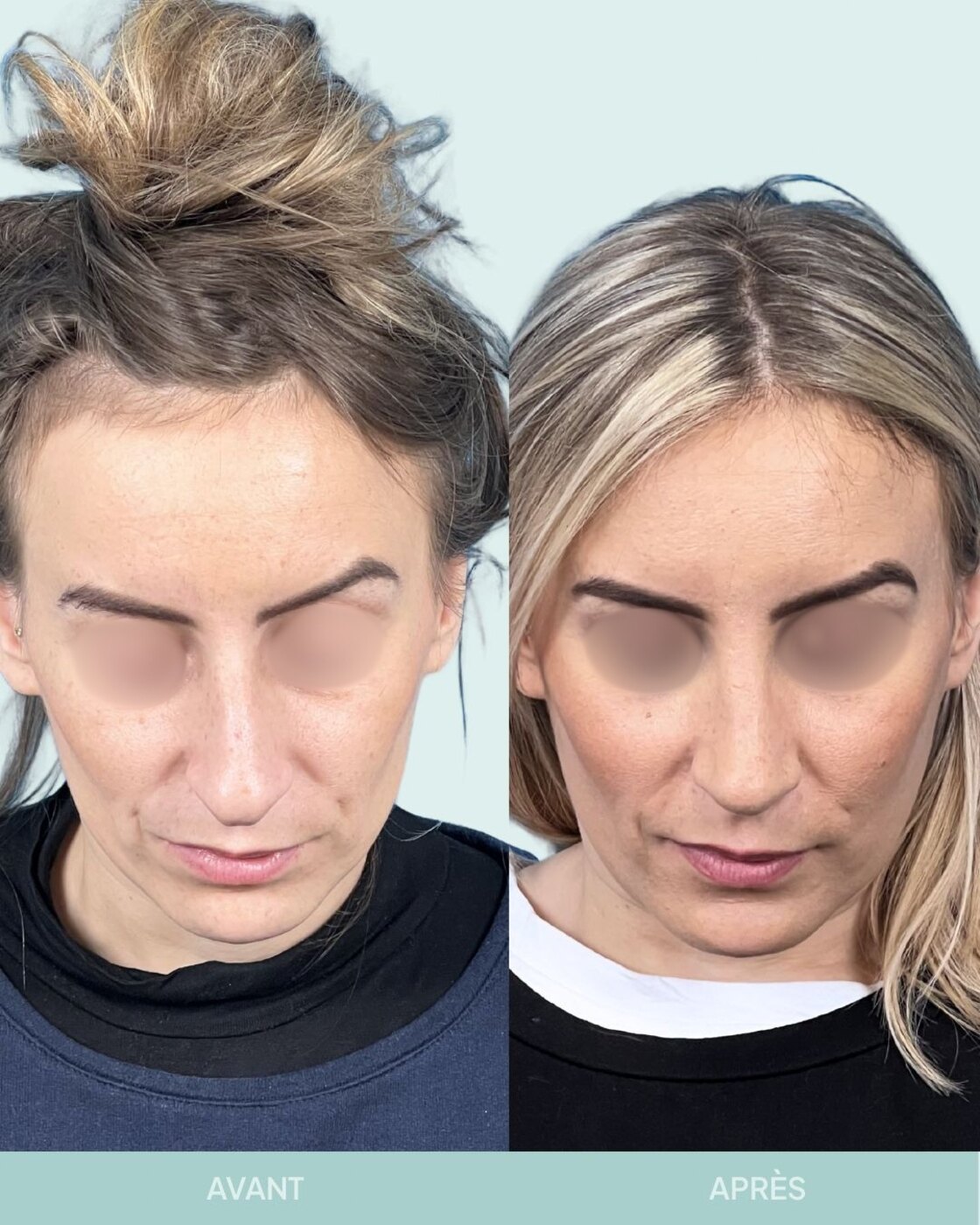 Avant / après rhinoplastie à Marseille — patiente 1 (Nez dévié à gauche, bosse, pointe tombante et hyper projetée), face (Dr Gagnieur)