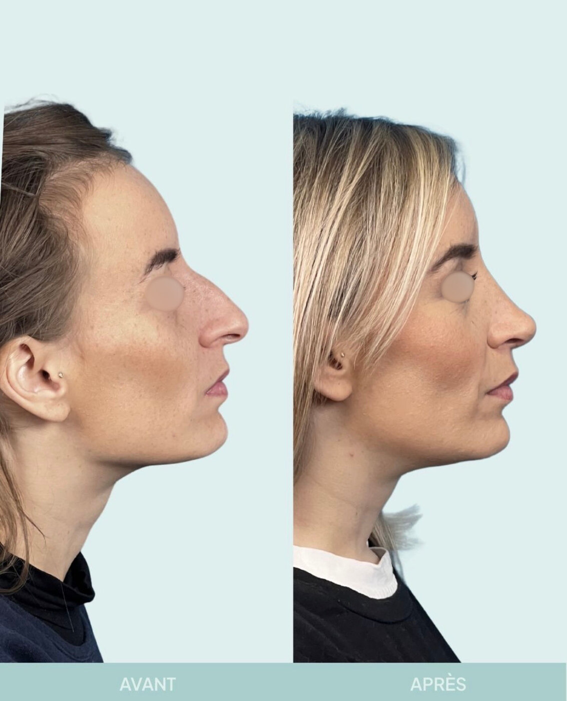 Avant / après rhinoplastie à Marseille — patiente 1 (Nez dévié à gauche, bosse, pointe tombante et hyper projetée), profil (Dr Gagnieur)