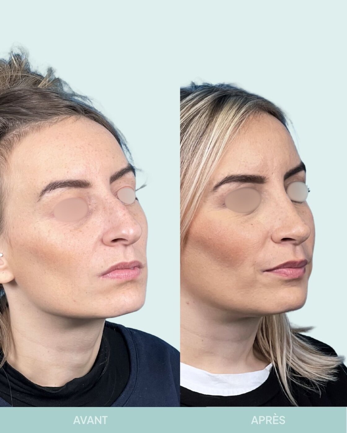 Avant / après rhinoplastie à Marseille — patiente 1 (Nez dévié à gauche, bosse, pointe tombante et hyper projetée), trois-quarts (Dr Gagnieur)