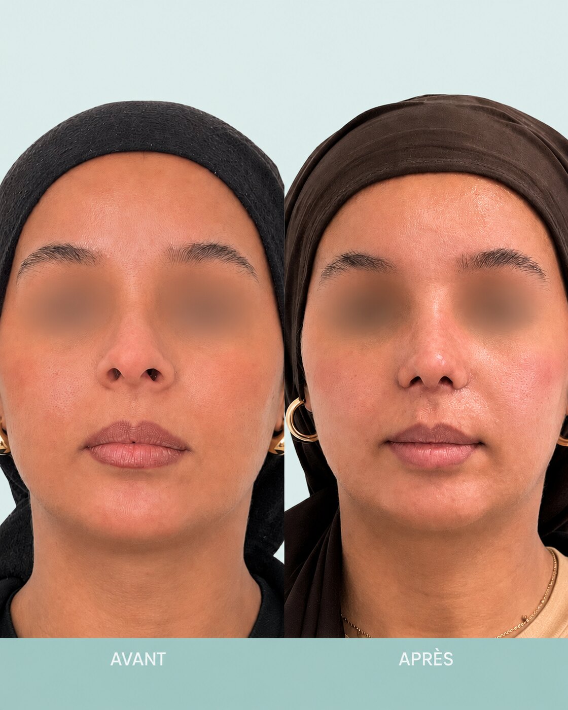 Avant / après rhinoplastie à Marseille — patiente 2 (Bosse, pointe tombante, asymétrie et excès de largeur des narines), face (Dr Gagnieur)