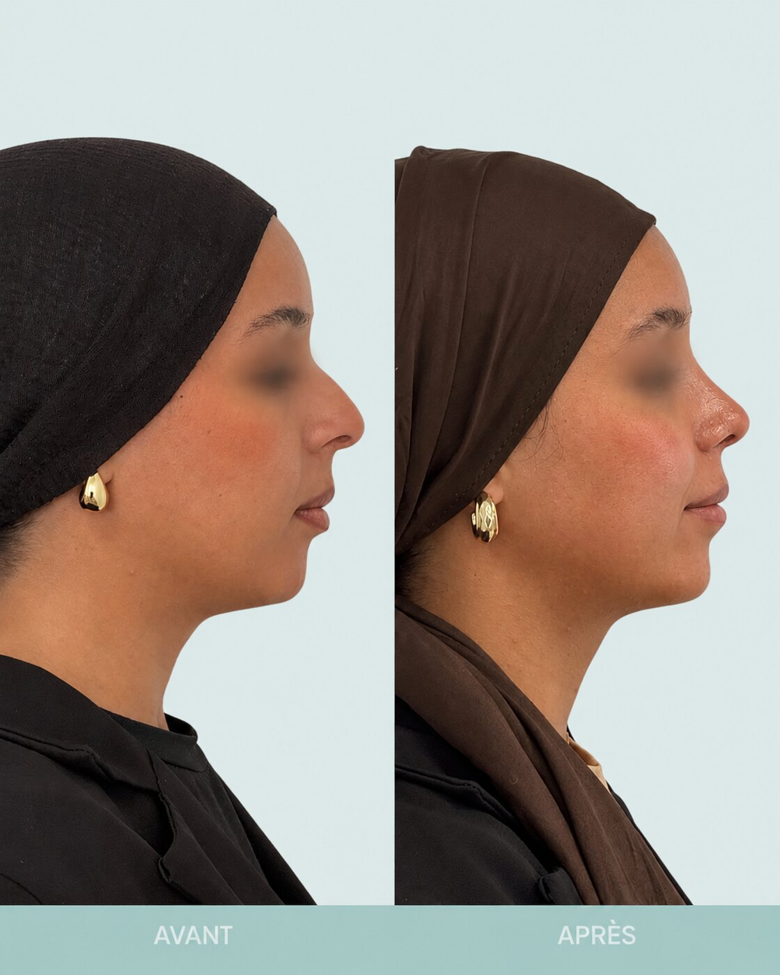Avant / après rhinoplastie à Marseille — patiente 2 (Bosse, pointe tombante, asymétrie et excès de largeur des narines), profil (Dr Gagnieur)