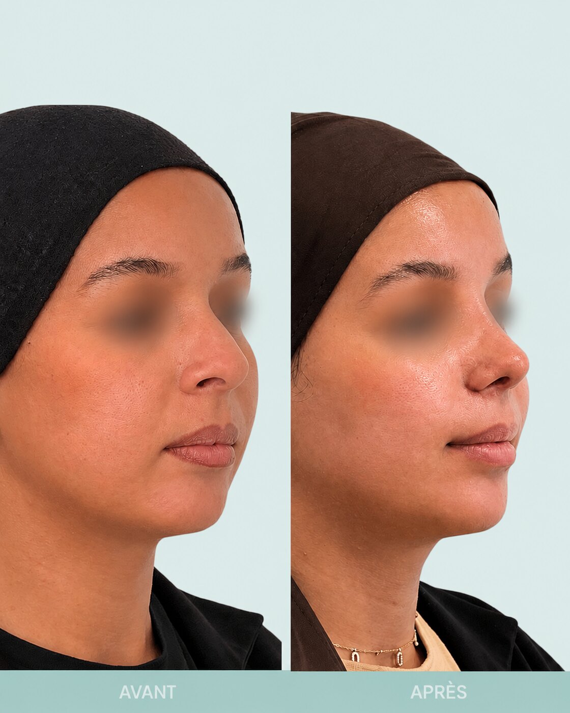 Avant / après rhinoplastie à Marseille — patiente 2 (Bosse, pointe tombante, asymétrie et excès de largeur des narines), trois-quarts (Dr Gagnieur)