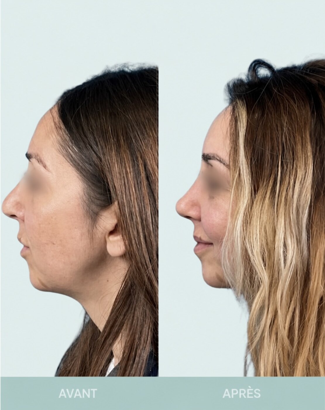 Avant / après rhinoplastie à Marseille — patiente 3 (Rhinoplastie secondaire pour bosse résiduelle, pointe tombante hypo projetée), profil (Dr Gagnieur)