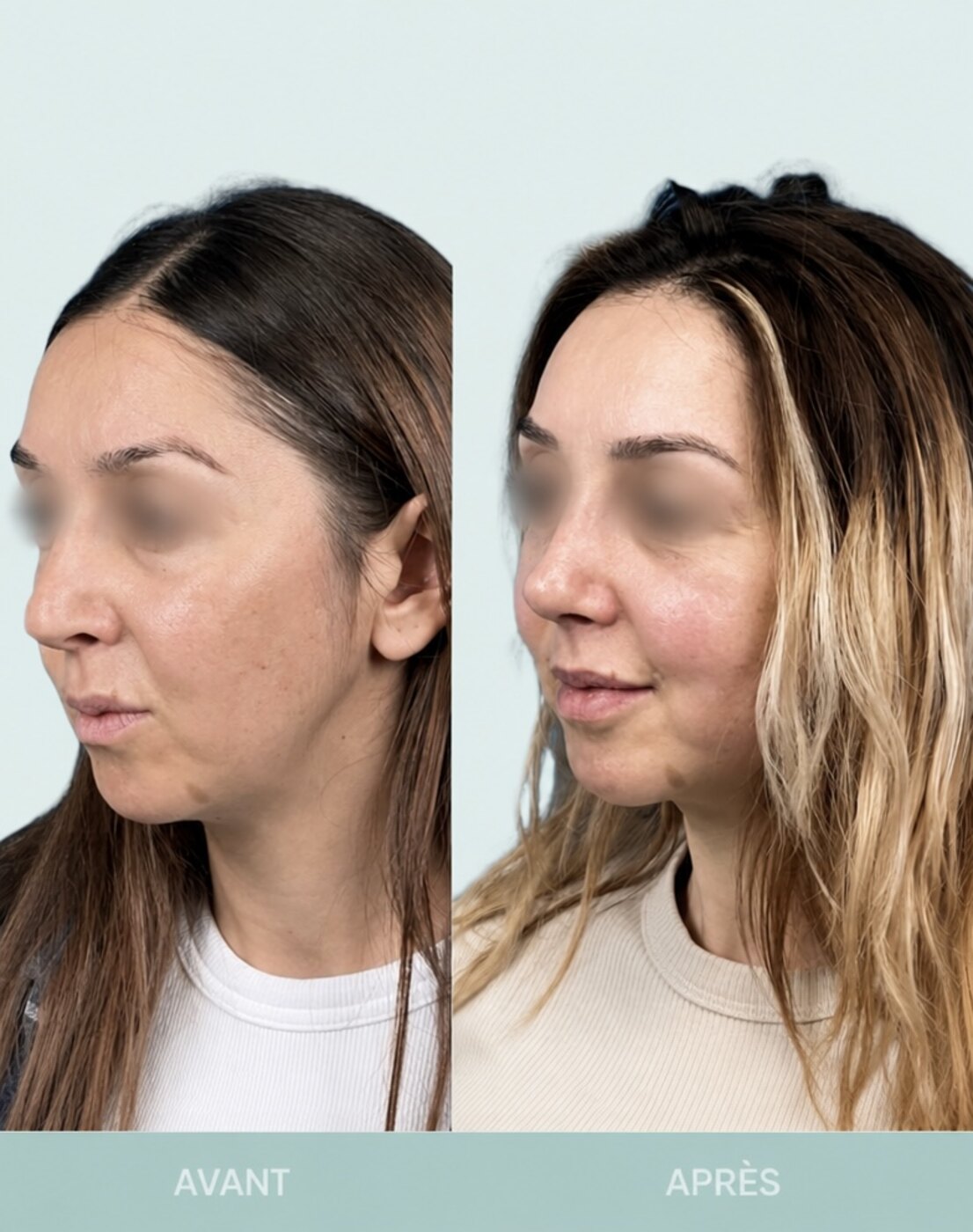 Avant / après rhinoplastie à Marseille — patiente 3 (Rhinoplastie secondaire pour bosse résiduelle, pointe tombante hypo projetée), trois-quarts (Dr Gagnieur)
