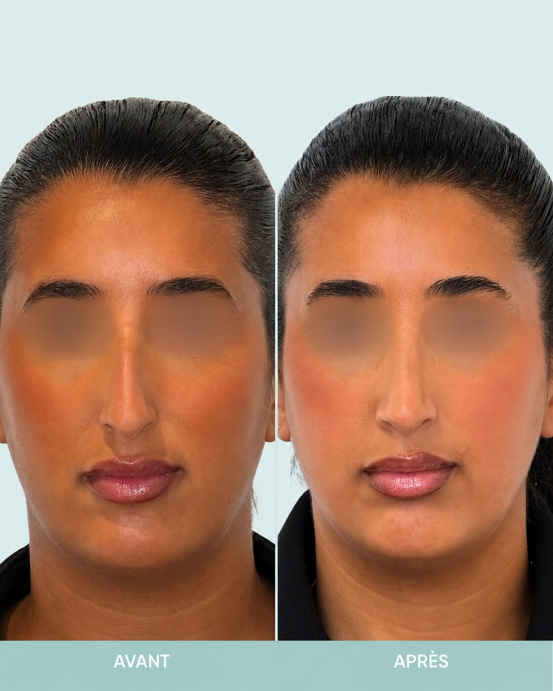 Avant / après rhinoplastie à Marseille — patiente 4 (Bosse majeure, pointe tombante et hyper projetée), face (Dr Gagnieur)
