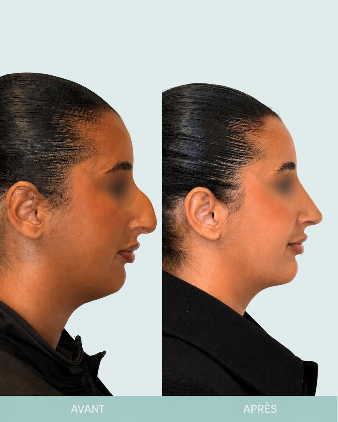 Avant / après rhinoplastie à Marseille — patiente 4 (Bosse majeure, pointe tombante et hyper projetée), profil (Dr Gagnieur)