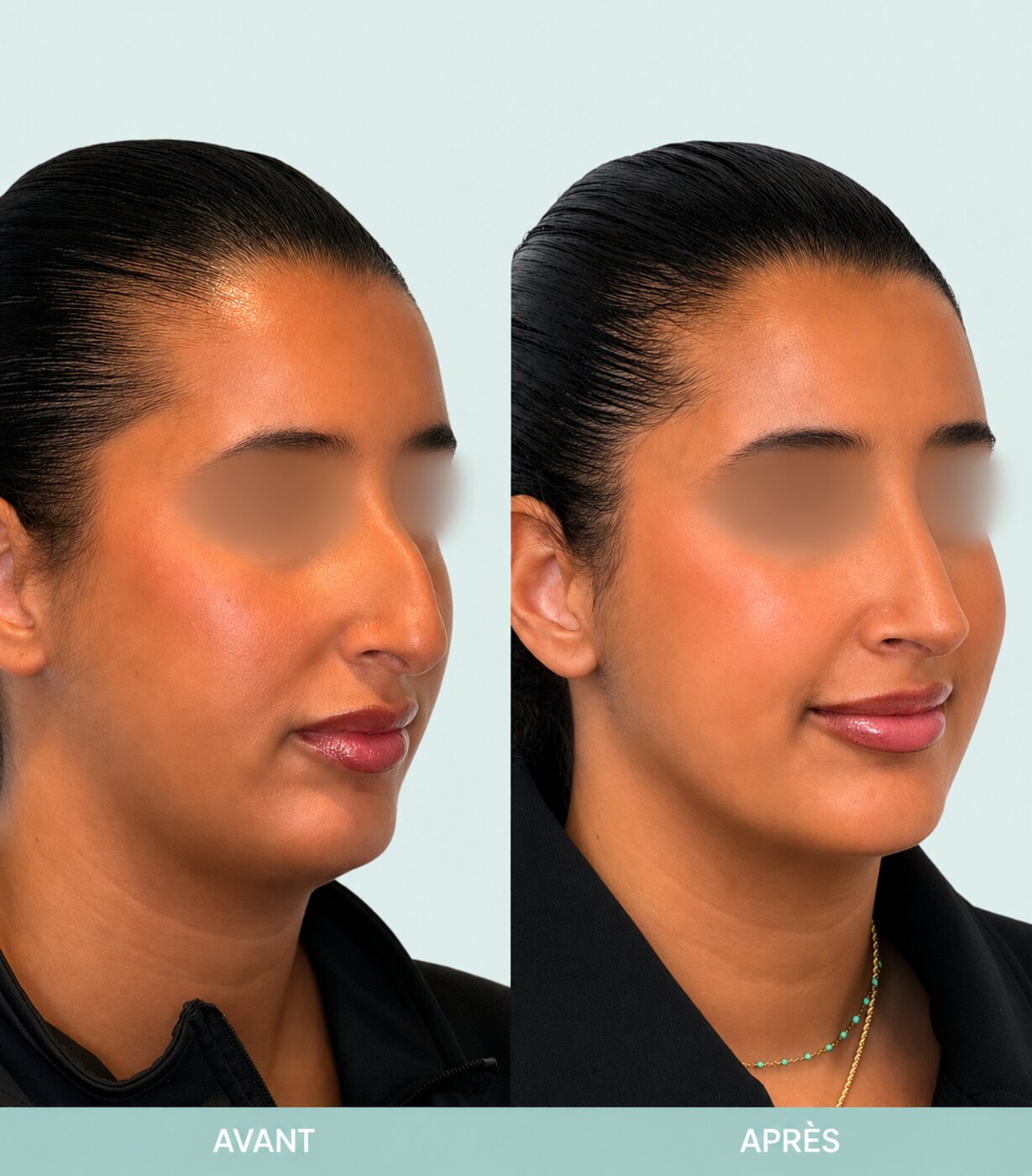 Avant / après rhinoplastie à Marseille — patiente 4 (Bosse majeure, pointe tombante et hyper projetée), trois-quarts (Dr Gagnieur)