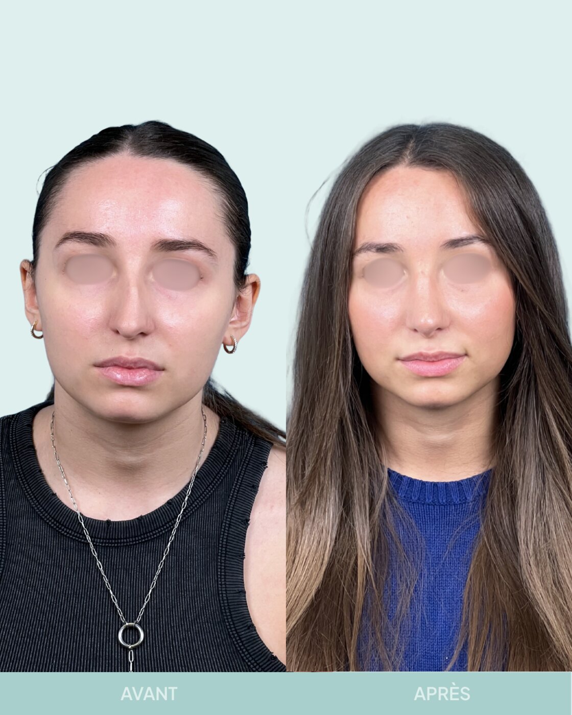 Avant / après rhinoplastie à Marseille — patiente 5 (Nez dévié à gauche, bosse, pointe tombante et hyper projetée), face (Dr Gagnieur)