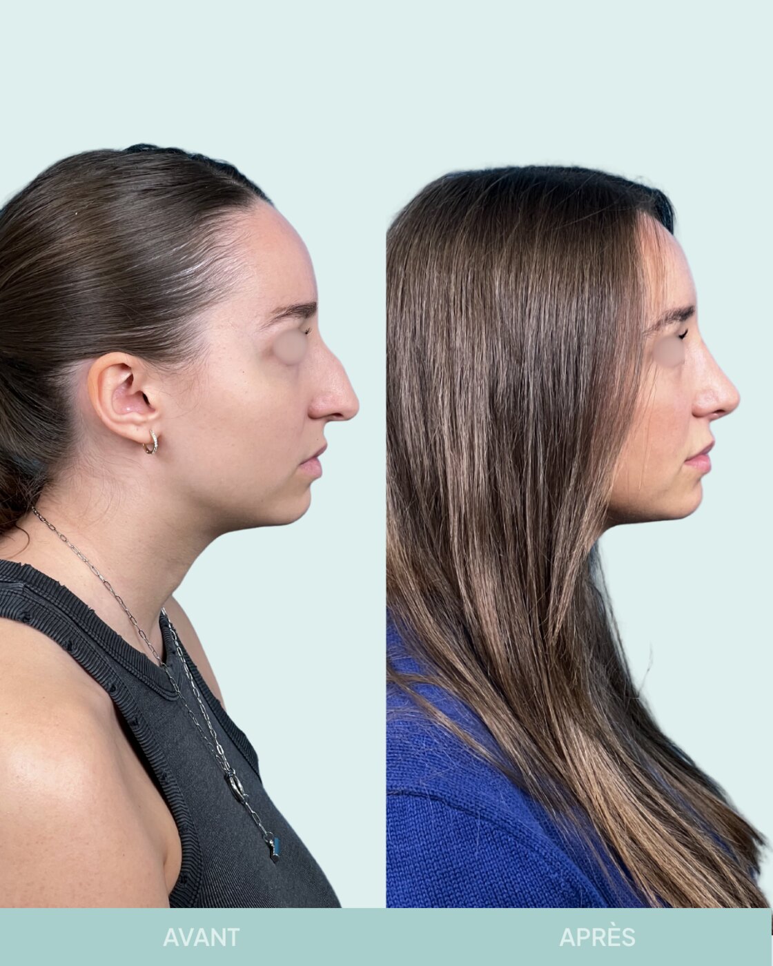 Avant / après rhinoplastie à Marseille — patiente 5 (Nez dévié à gauche, bosse, pointe tombante et hyper projetée), profil (Dr Gagnieur)