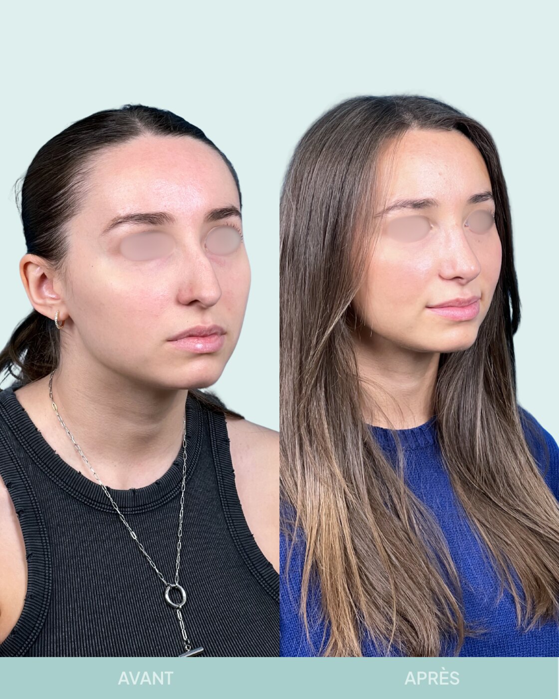 Avant / après rhinoplastie à Marseille — patiente 5 (Nez dévié à gauche, bosse, pointe tombante et hyper projetée), trois-quarts (Dr Gagnieur)