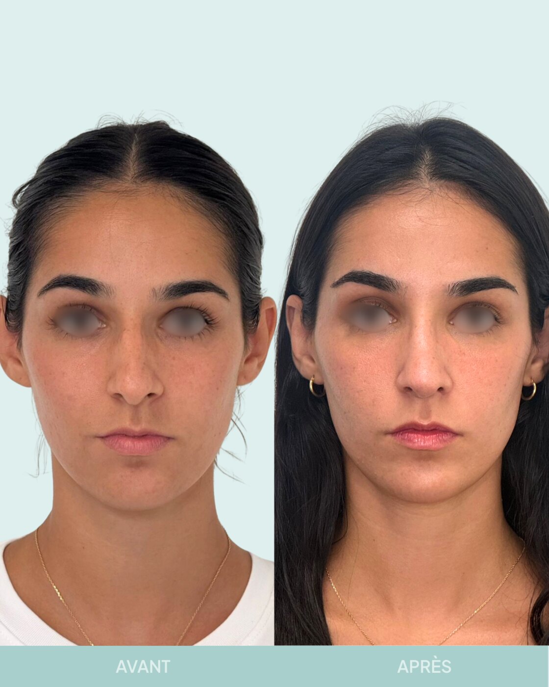 Avant / après rhinoplastie à Marseille — patiente 6 (Nez sous tension avec bosse, pointe tombante et hyper projetée), face (Dr Gagnieur)