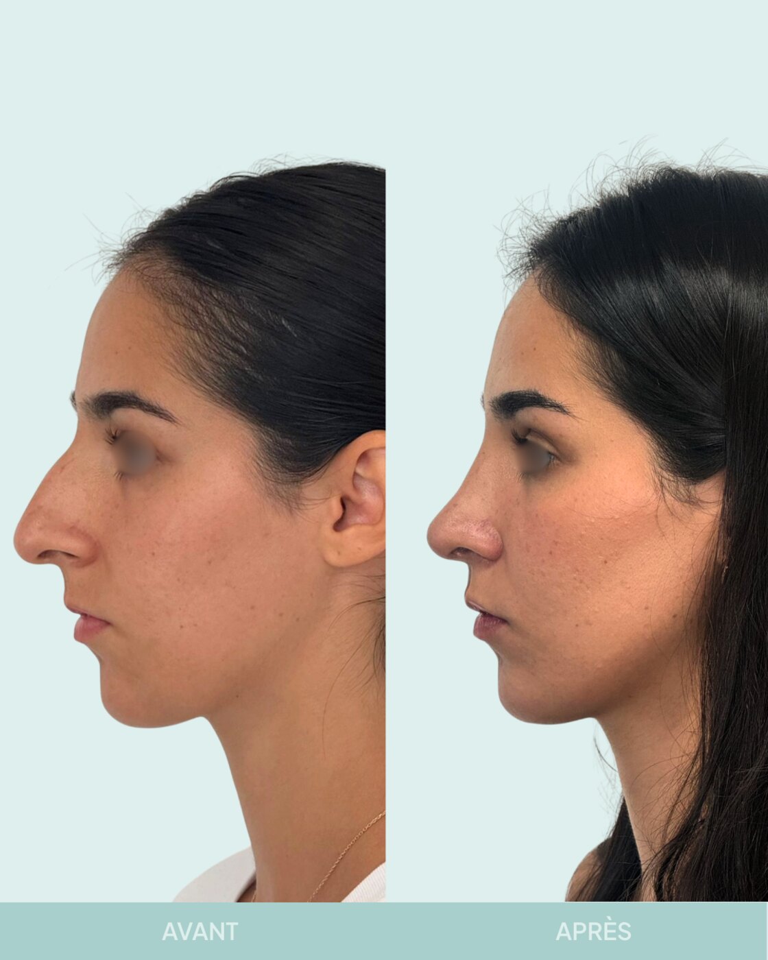 Avant / après rhinoplastie à Marseille — patiente 6 (Nez sous tension avec bosse, pointe tombante et hyper projetée), profil (Dr Gagnieur)