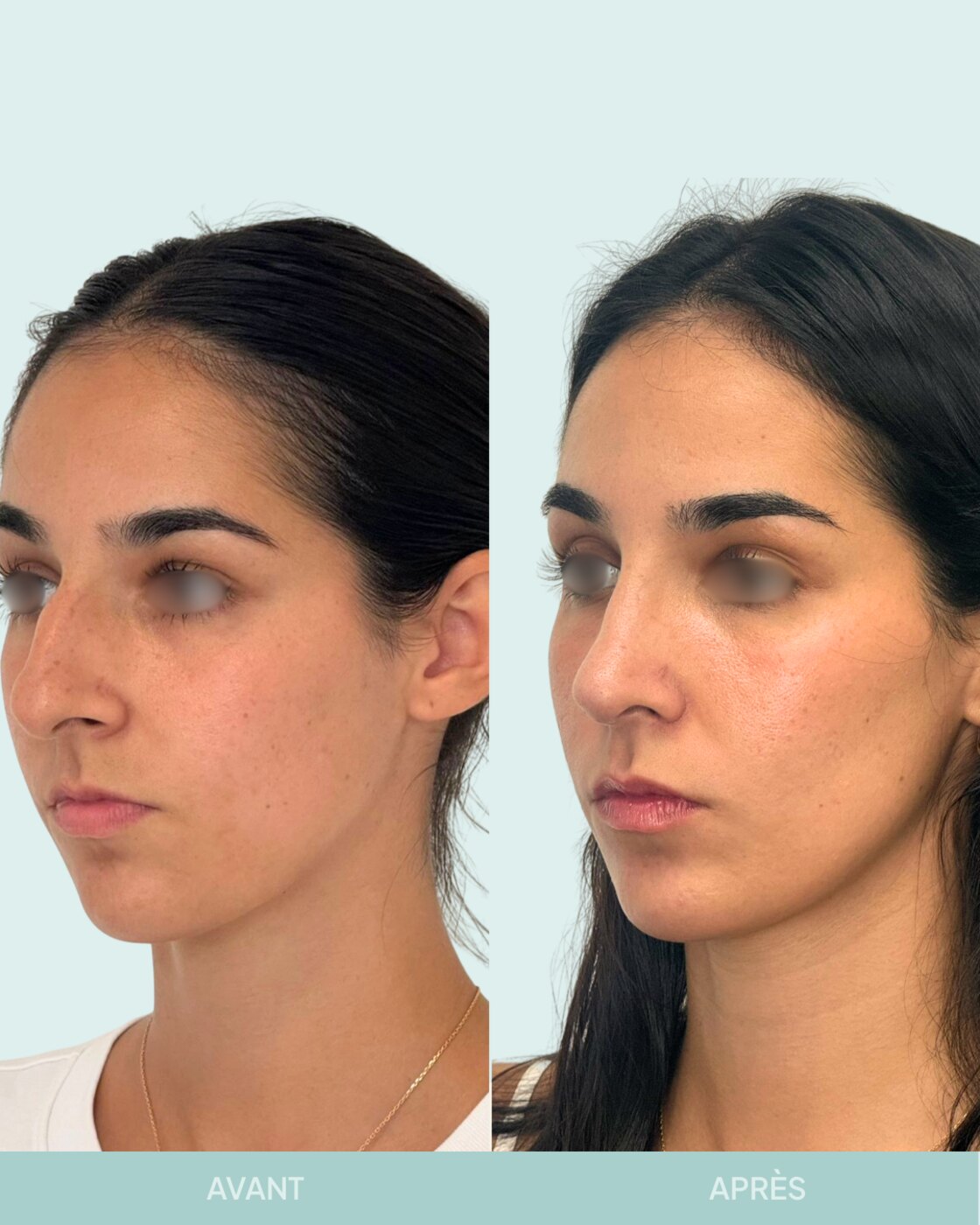 Avant / après rhinoplastie à Marseille — patiente 6 (Nez sous tension avec bosse, pointe tombante et hyper projetée), trois-quarts (Dr Gagnieur)