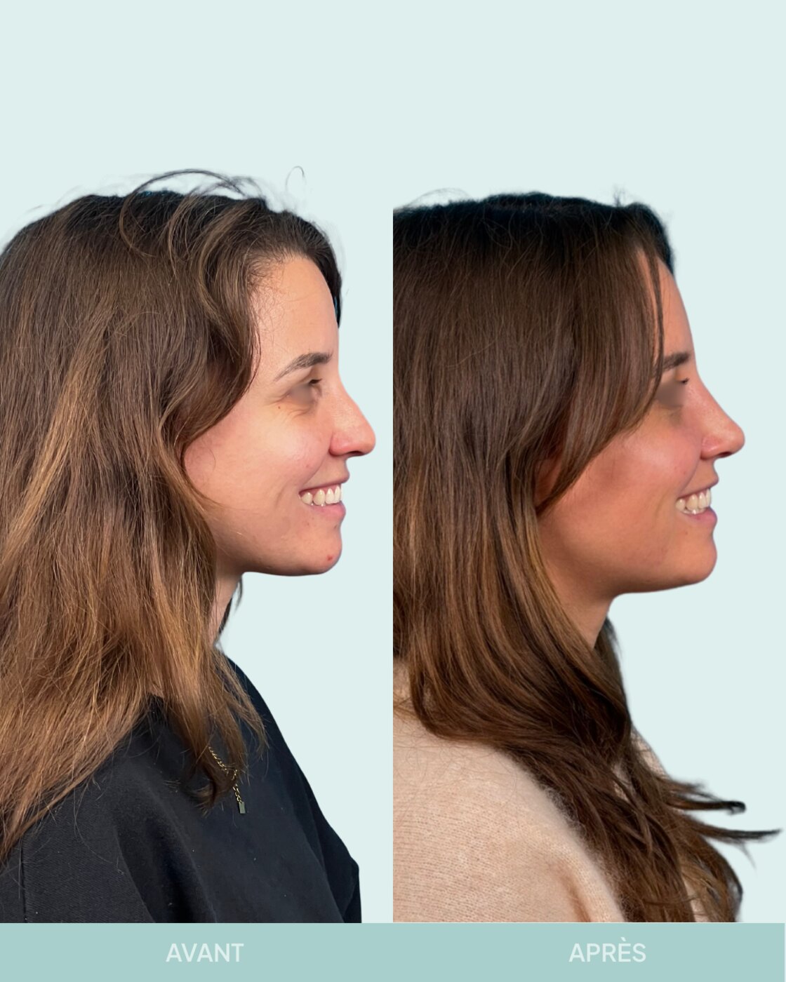 Avant / après rhinoplastie à Marseille — patiente 7 (Rhinoplastie secondaire pour petite bosse résiduelle et pointe tombante), vue 1 (Dr Gagnieur)