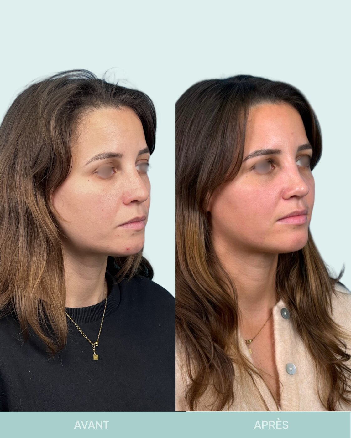 Avant / après rhinoplastie à Marseille — patiente 7 (Rhinoplastie secondaire pour petite bosse résiduelle et pointe tombante), vue 2 (Dr Gagnieur)