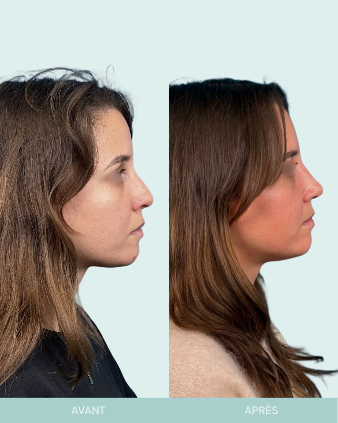 Avant / après rhinoplastie à Marseille — patiente 7 (Rhinoplastie secondaire pour petite bosse résiduelle et pointe tombante), vue 3 (Dr Gagnieur)