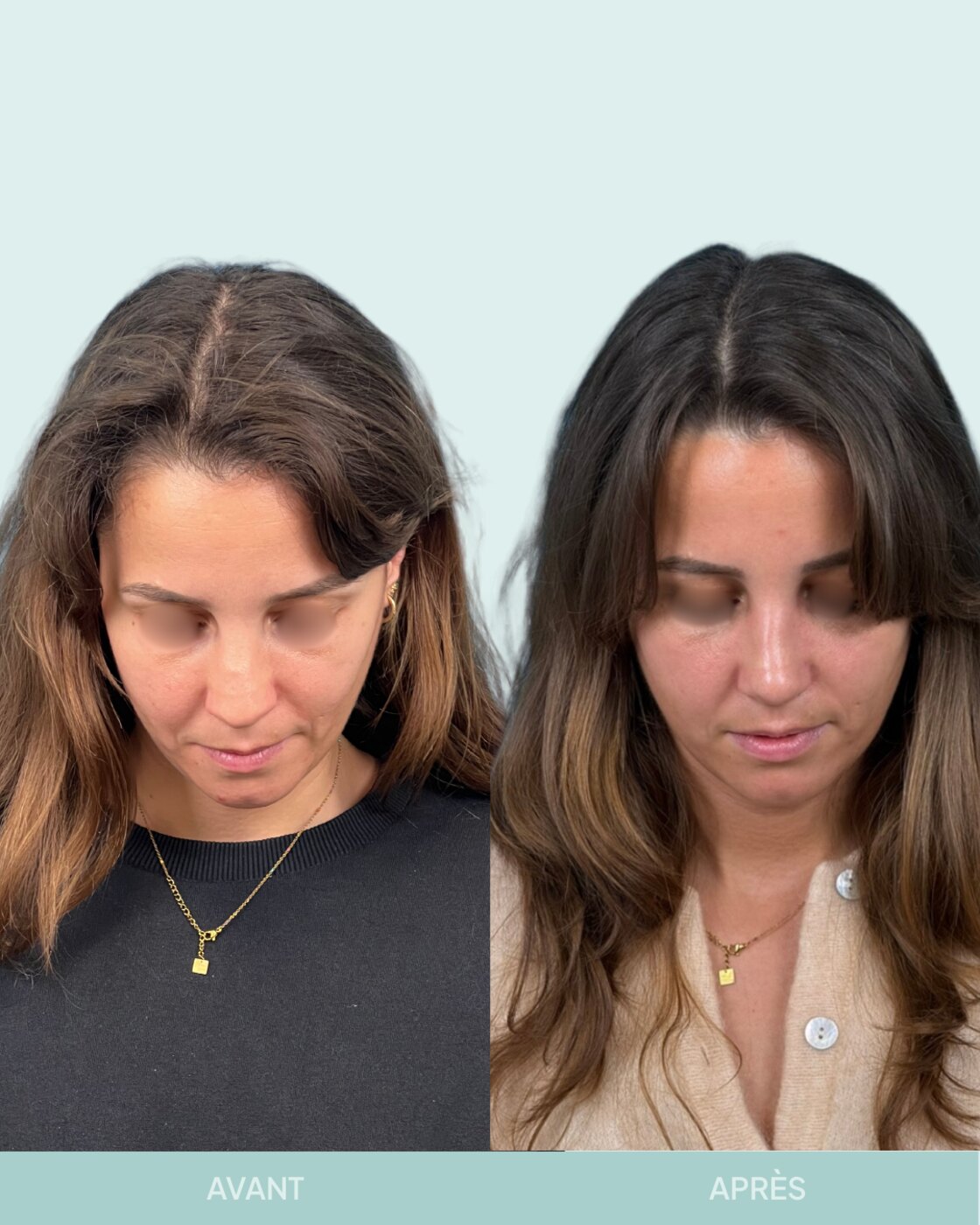 Avant / après rhinoplastie à Marseille — patiente 7 (Rhinoplastie secondaire pour petite bosse résiduelle et pointe tombante), vue 4 (Dr Gagnieur)