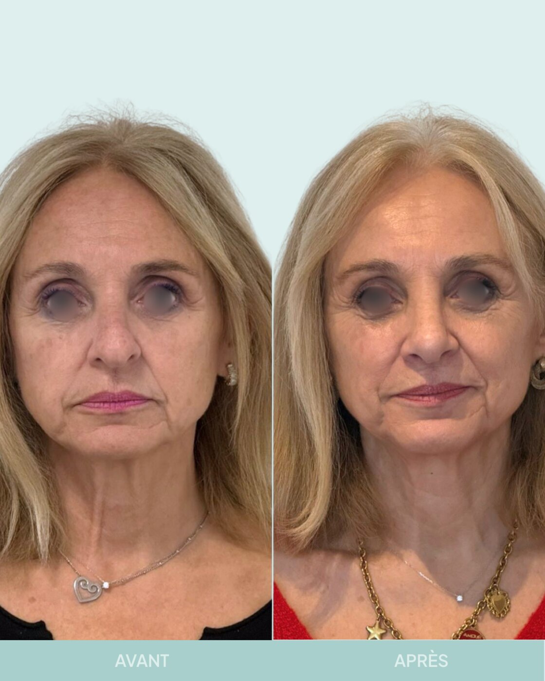 Avant / après rhinoplastie à Marseille — patiente 8 (Nez sous tension avec bosse, pointe tombante et hyper projetée), face (Dr Gagnieur)