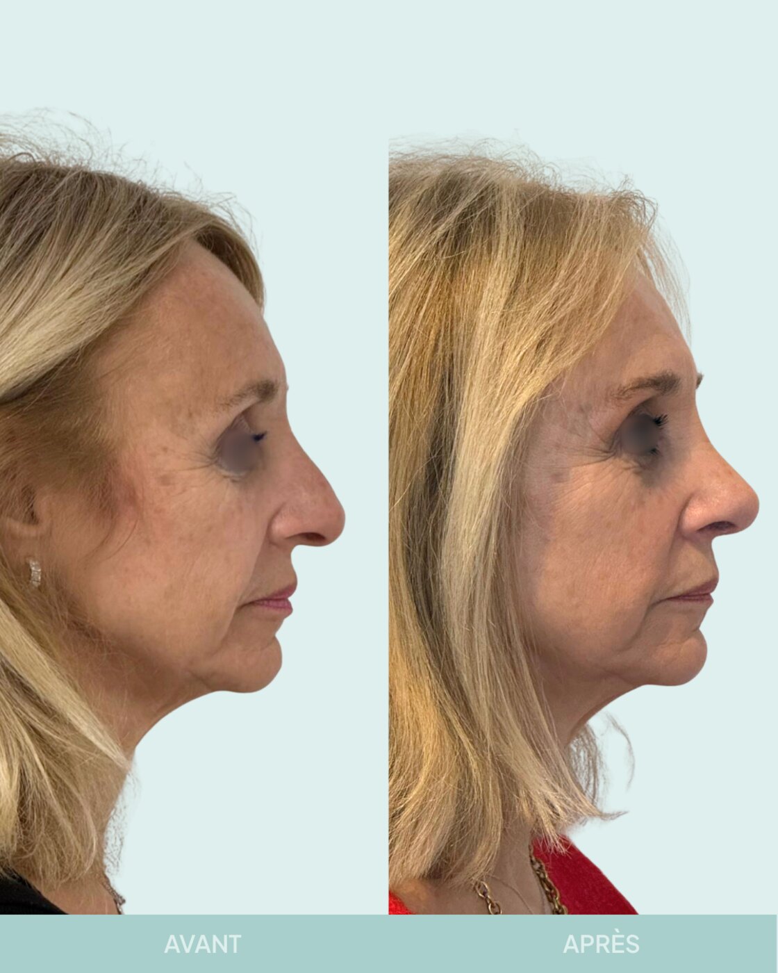 Avant / après rhinoplastie à Marseille — patiente 8 (Nez sous tension avec bosse, pointe tombante et hyper projetée), profil (Dr Gagnieur)