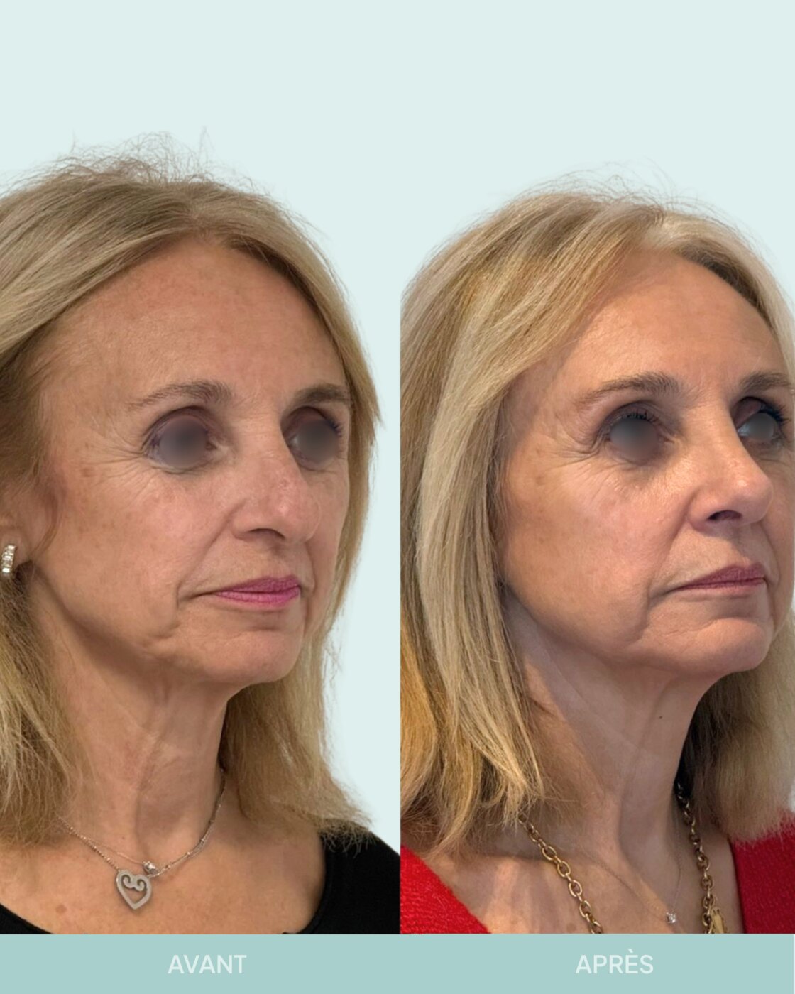 Avant / après rhinoplastie à Marseille — patiente 8 (Nez sous tension avec bosse, pointe tombante et hyper projetée), trois-quarts (Dr Gagnieur)