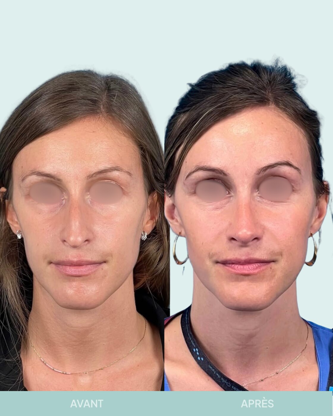 Avant / après rhinoplastie à Marseille — patiente 9 (Bosse, pointe tombante et hypo projetée), face (Dr Gagnieur)