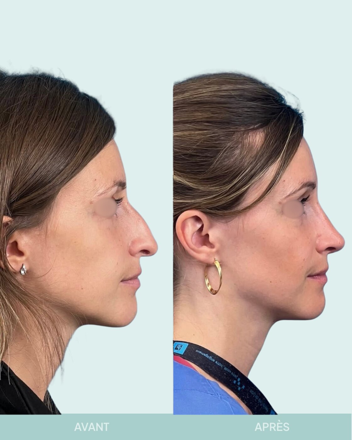 Avant / après rhinoplastie à Marseille — patiente 9 (Bosse, pointe tombante et hypo projetée), profil (Dr Gagnieur)