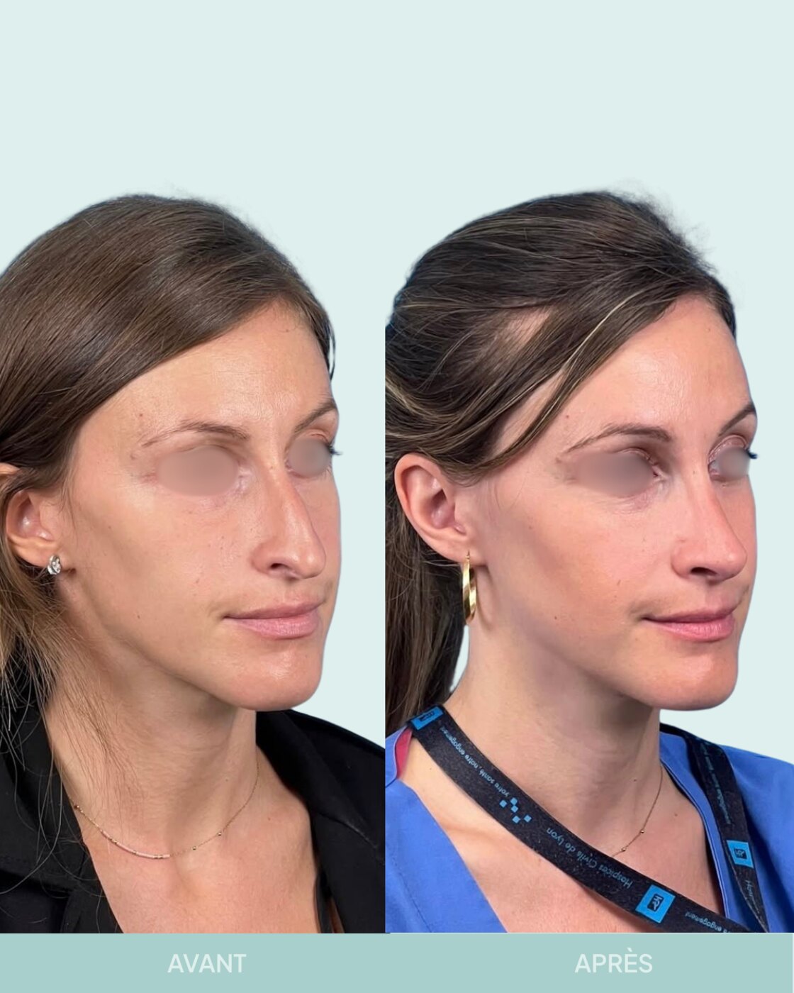 Avant / après rhinoplastie à Marseille — patiente 9 (Bosse, pointe tombante et hypo projetée), trois-quarts (Dr Gagnieur)
