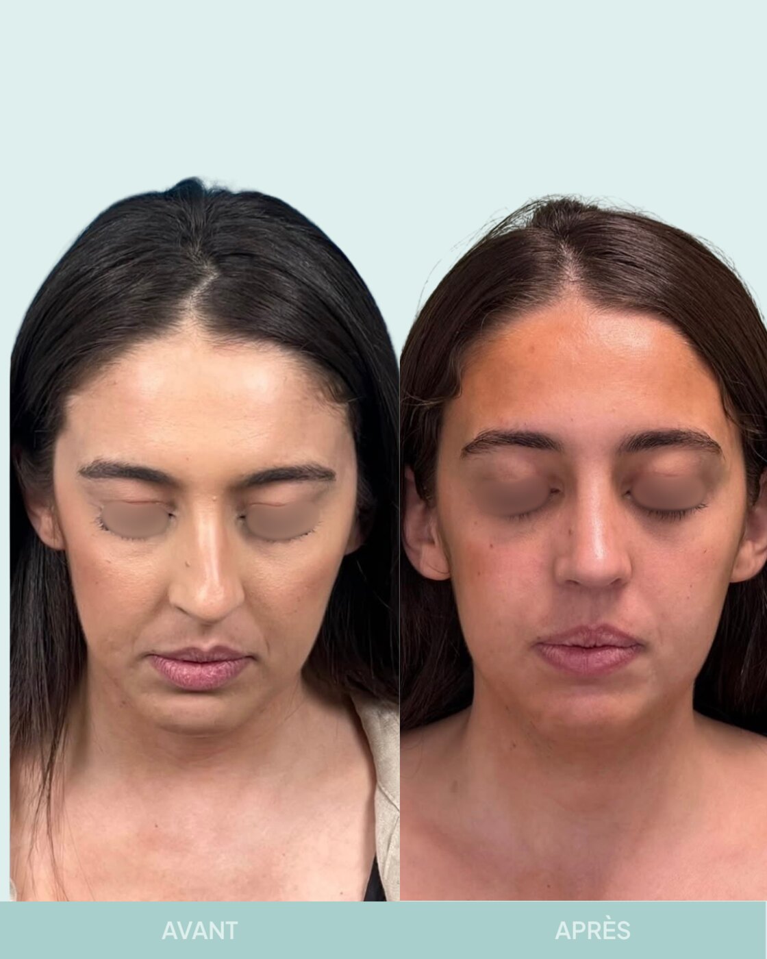 Avant / après rhinoplastie à Marseille — patiente 10 (Radix hyper projeté et nez sous tension), face (Dr Gagnieur)