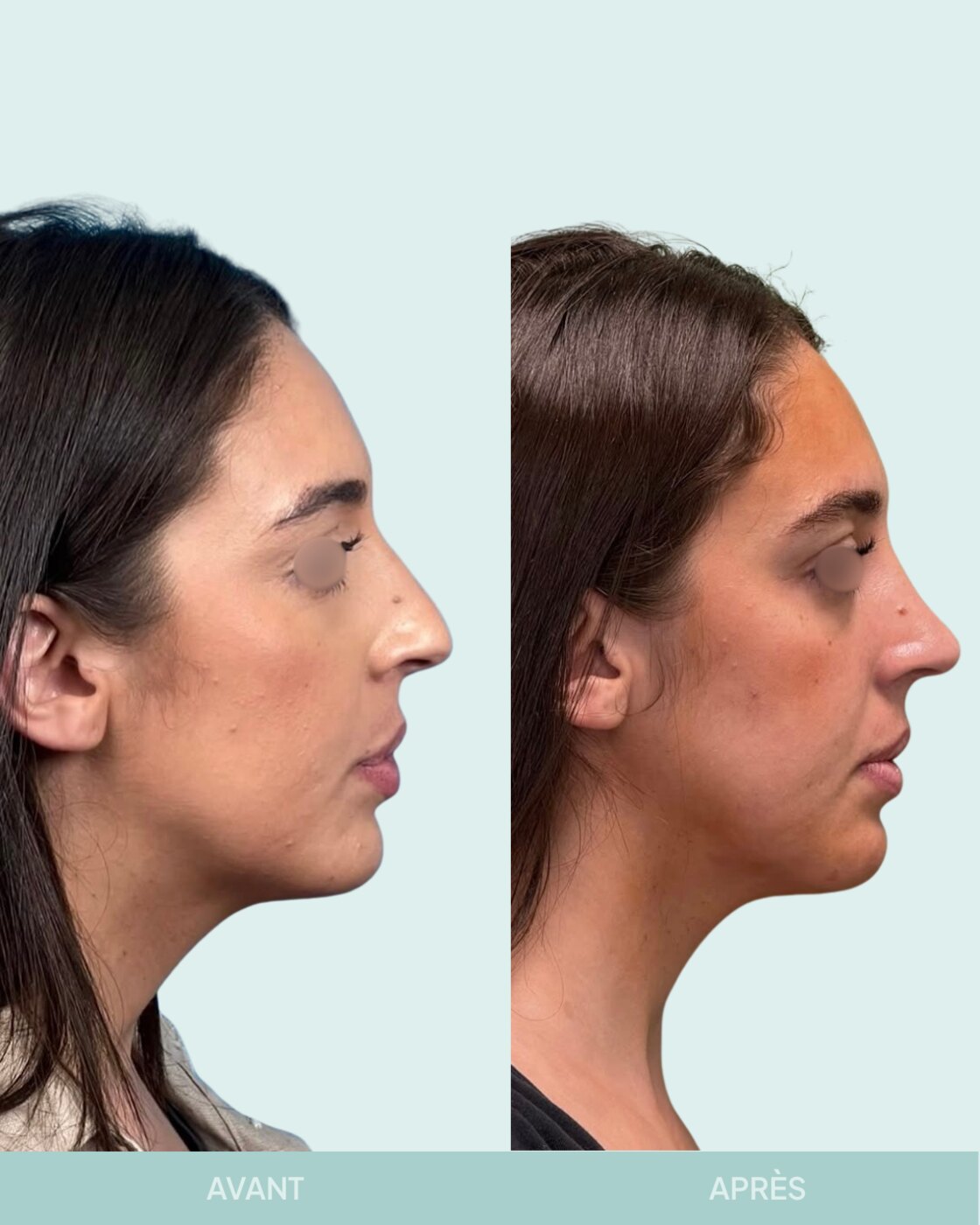 Avant / après rhinoplastie à Marseille — patiente 10 (Radix hyper projeté et nez sous tension), profil (Dr Gagnieur)