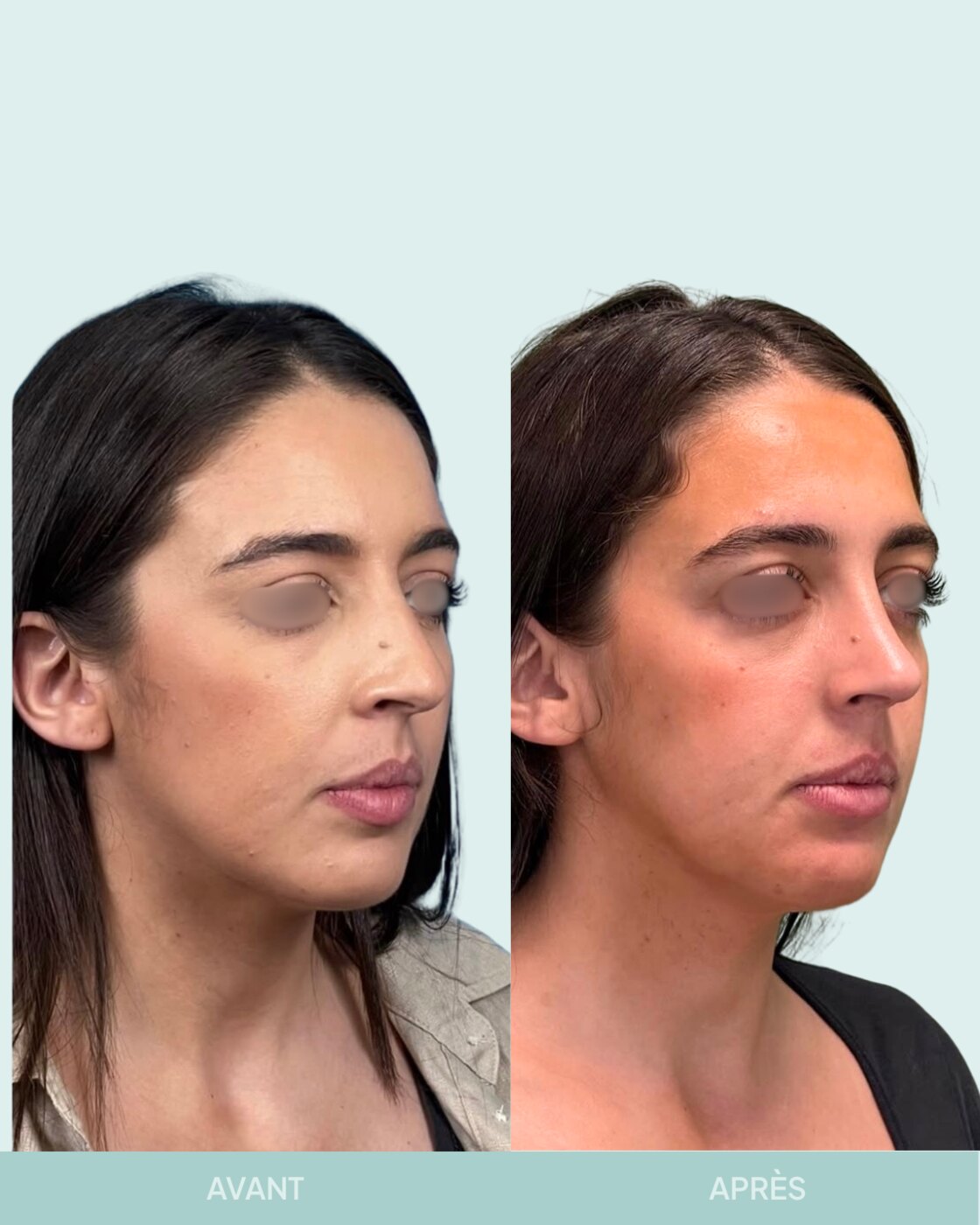 Avant / après rhinoplastie à Marseille — patiente 10 (Radix hyper projeté et nez sous tension), trois-quarts (Dr Gagnieur)