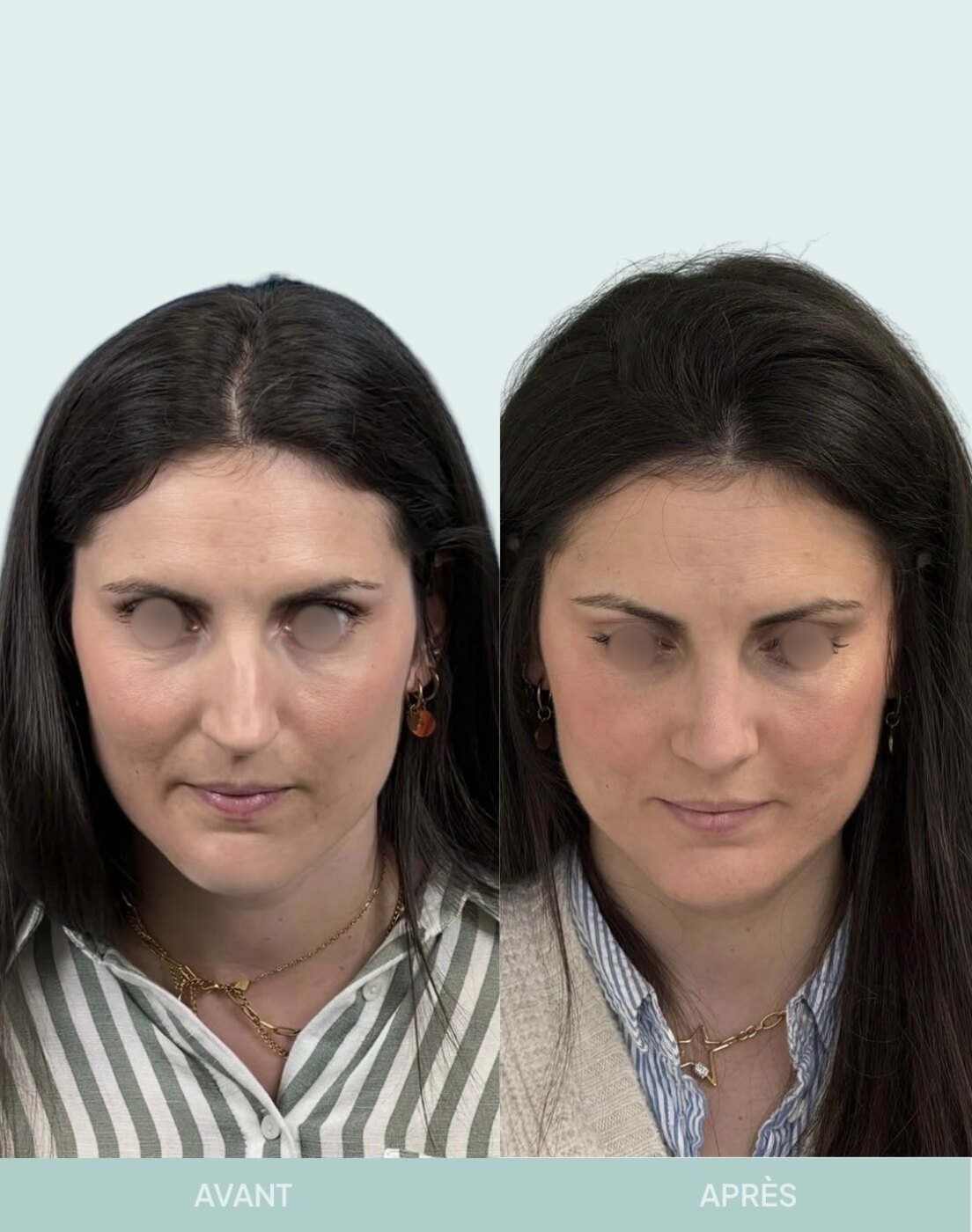 Avant / après rhinoplastie à Marseille — patiente 11 (Radix hyper projeté, bosse, pointe tombante), vue 1 (Dr Gagnieur)