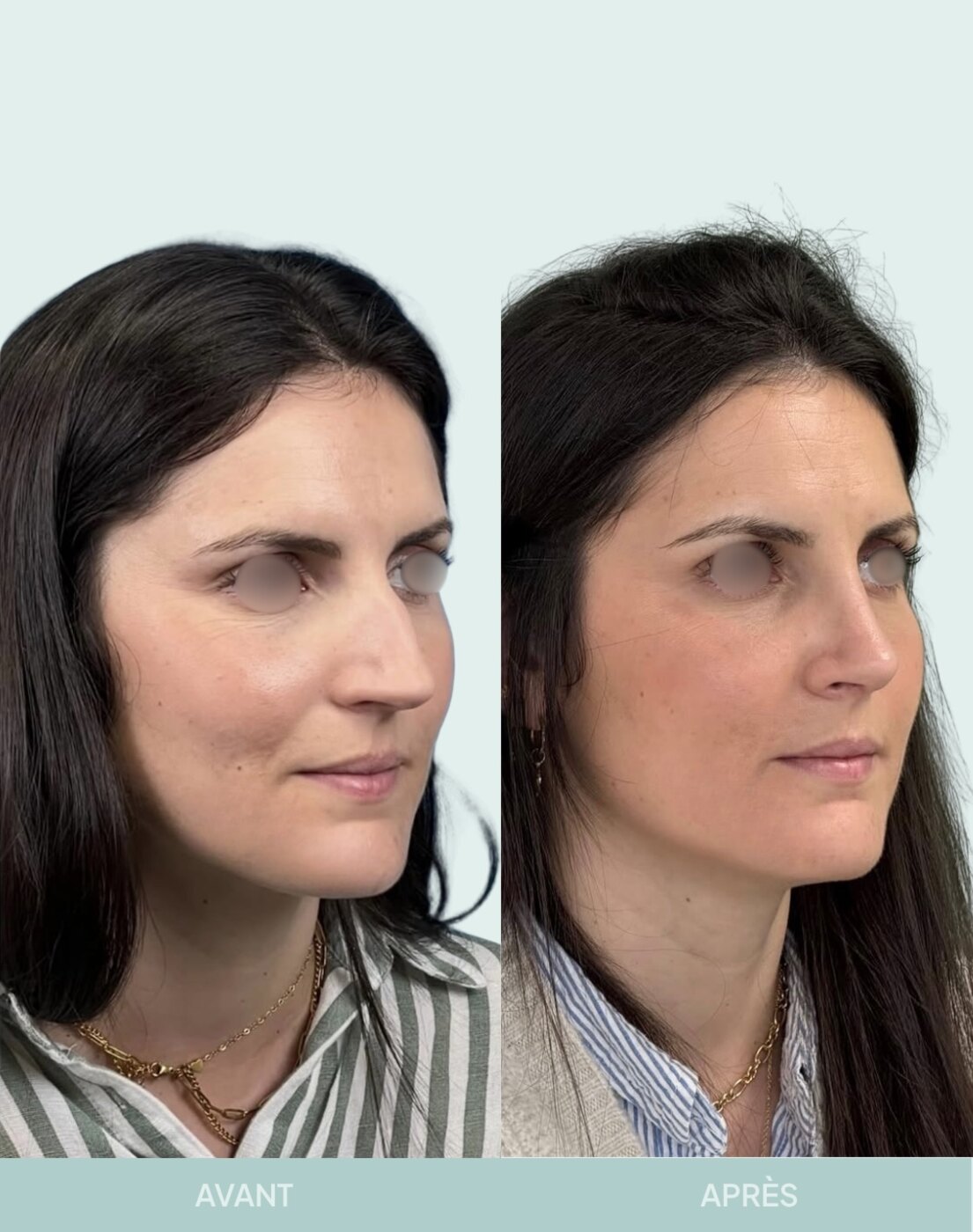 Avant / après rhinoplastie à Marseille — patiente 11 (Radix hyper projeté, bosse, pointe tombante), vue 2 (Dr Gagnieur)