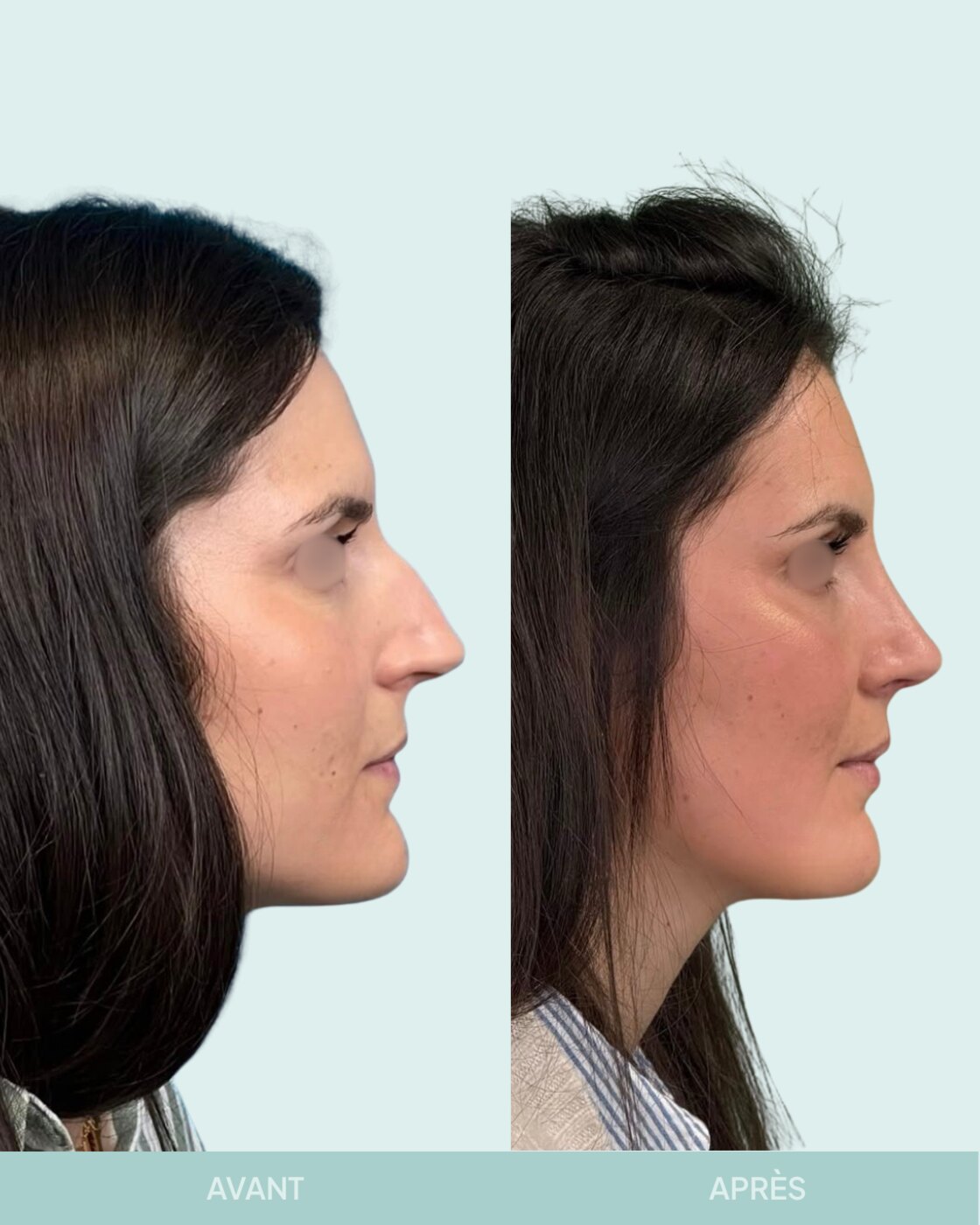 Avant / après rhinoplastie à Marseille — patiente 11 (Radix hyper projeté, bosse, pointe tombante), vue 3 (Dr Gagnieur)