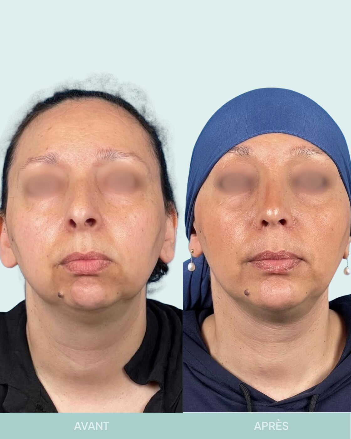 Avant / après rhinoplastie à Marseille — patiente 12 (Profiloplastie : rhinoplastie associée à une chirurgie du menton pour rééquilibrer le profil), face (Dr Gagnieur)