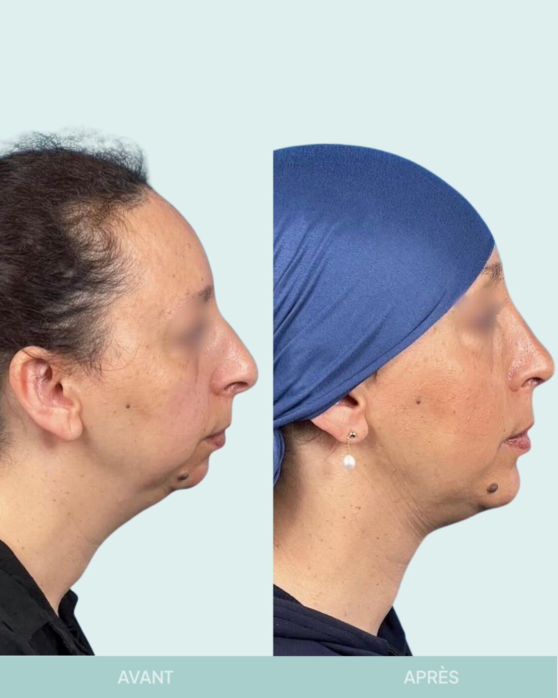 Avant / après rhinoplastie à Marseille — patiente 12 (Profiloplastie : rhinoplastie associée à une chirurgie du menton pour rééquilibrer le profil), profil (Dr Gagnieur)