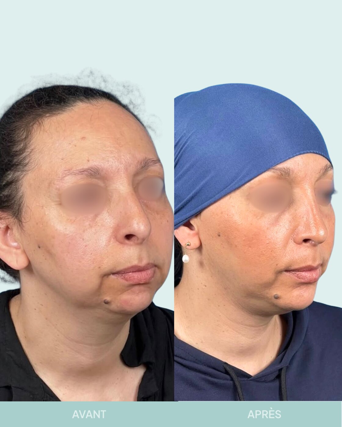 Avant / après rhinoplastie à Marseille — patiente 12 (Profiloplastie : rhinoplastie associée à une chirurgie du menton pour rééquilibrer le profil), trois-quarts (Dr Gagnieur)